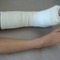 Broken%20ankle_small_square